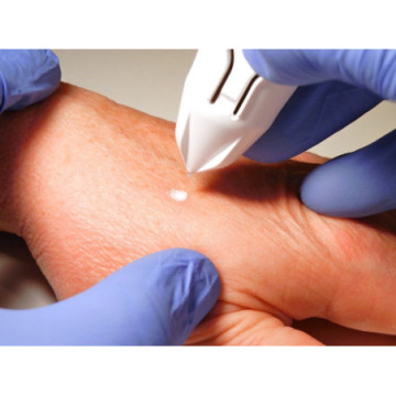 Dispositivo criochirurgico Cryoclear con cartuccia 16 g