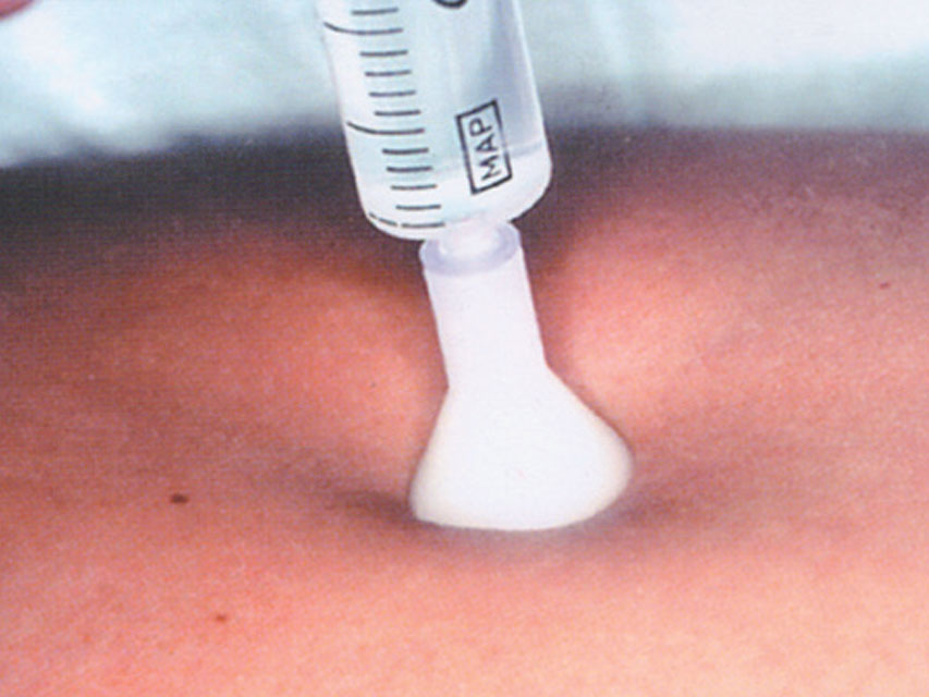 Aghi per micro-mesoterapia Meso-relle con ago tipo S.I.T. 31G 0,26 x 2,5 mm - bianco - Conf.25 pz.