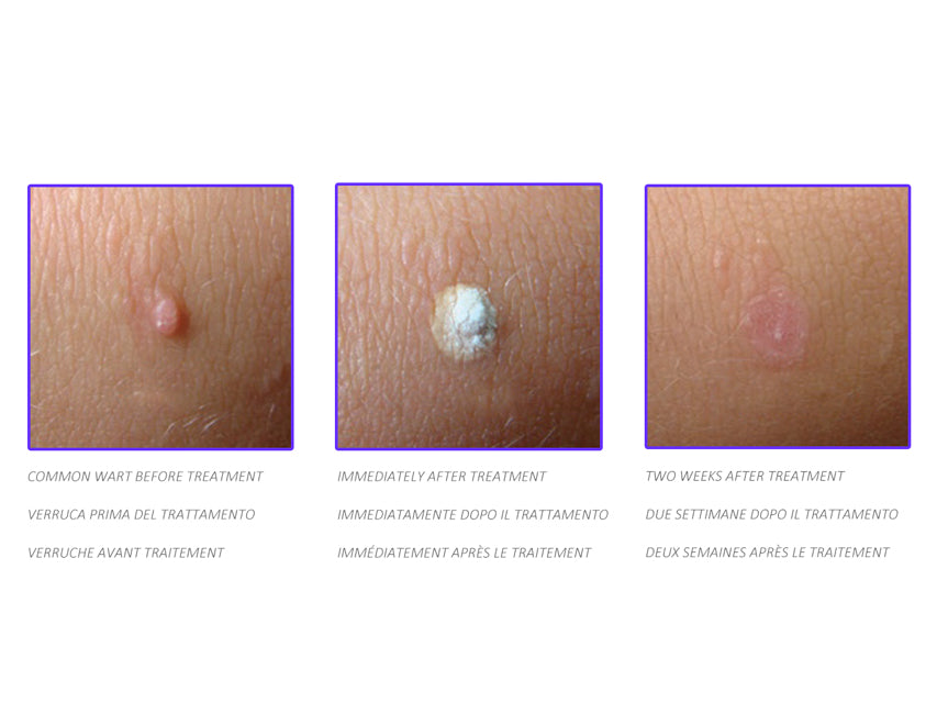 Dispositivo criochirurgico Cryomega con cartuccia 16 g