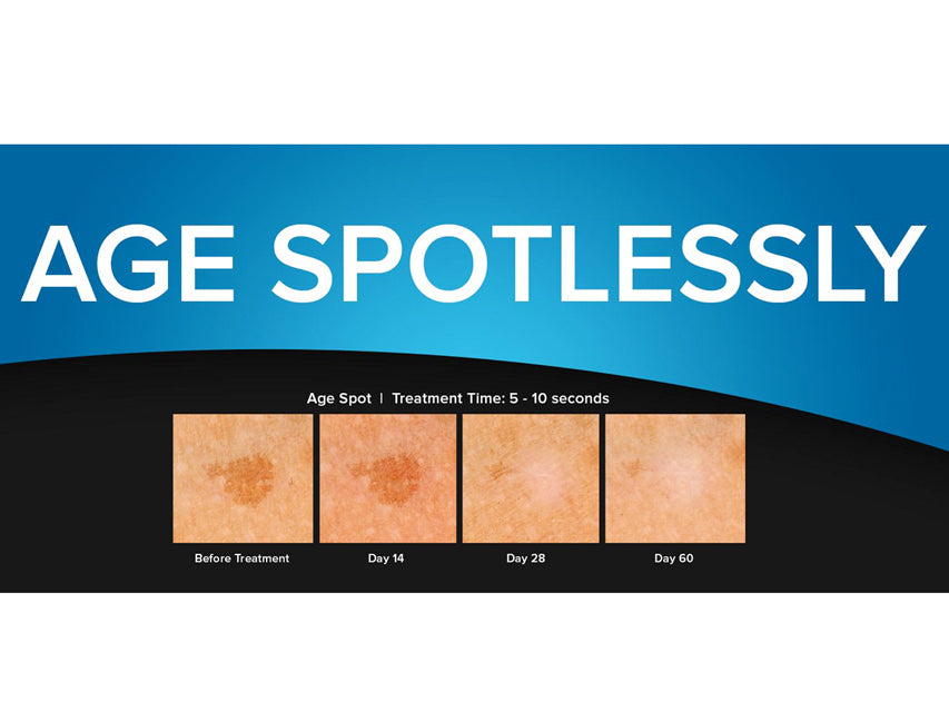 Cryochirurgisches Gerät Cryoclear mit Patrone 16 g