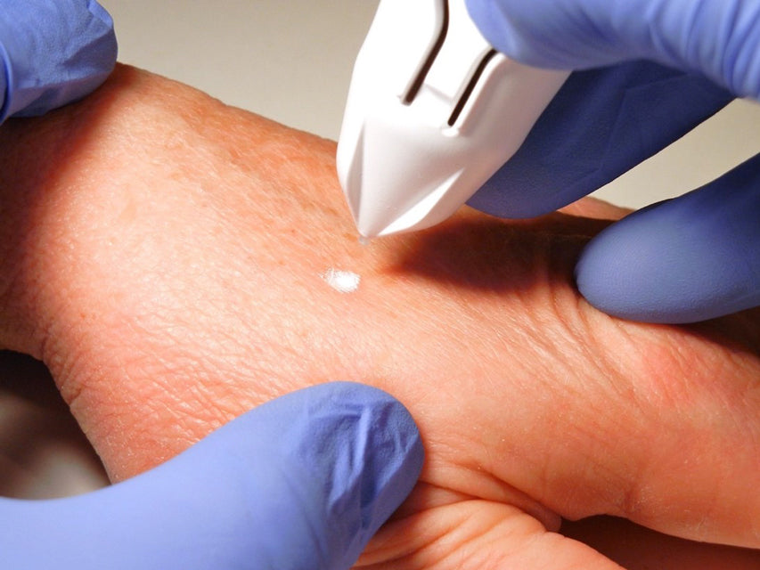 Cryochirurgisches Gerät Cryoclear mit Patrone 16 g