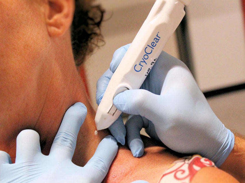 Cryochirurgisches Gerät Cryoclear mit Patrone 16 g