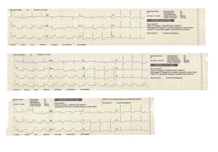 Ecg mindray beneheart R3 cardiografo portatile e leggero per la diagnosi tramite ECG a riposo