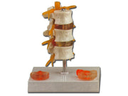 MODELL DER HERNIENPATHOLOGIE