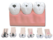Caries model - 1 pc.