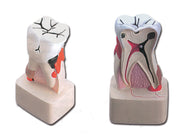 Modello patologia dentale - 1 pz.