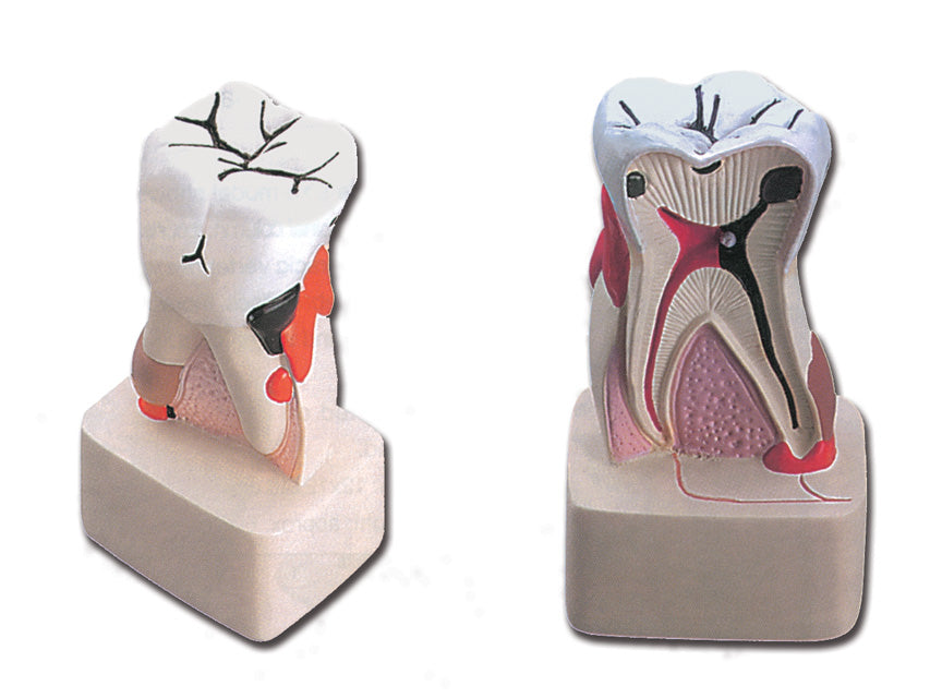 Modello patologia dentale - 1 pz.