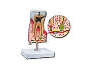 Lower molar with caries